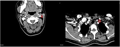 Diagnosis of cervical lymph node metastasis with thyroid carcinoma by deep learning application to CT images